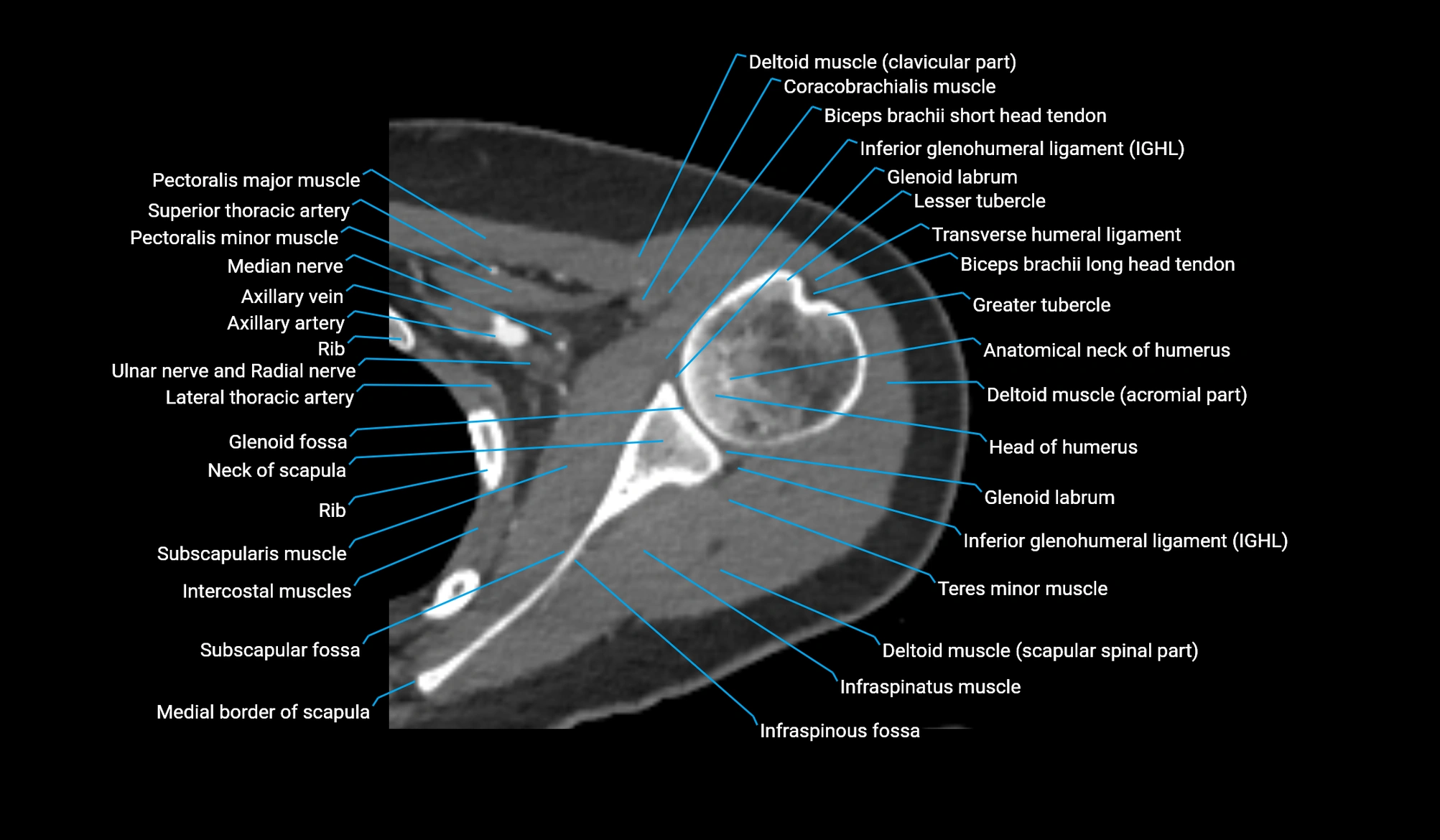 CT upper arm axial  cross sectional anatomy labelled radiology image -00098.webp